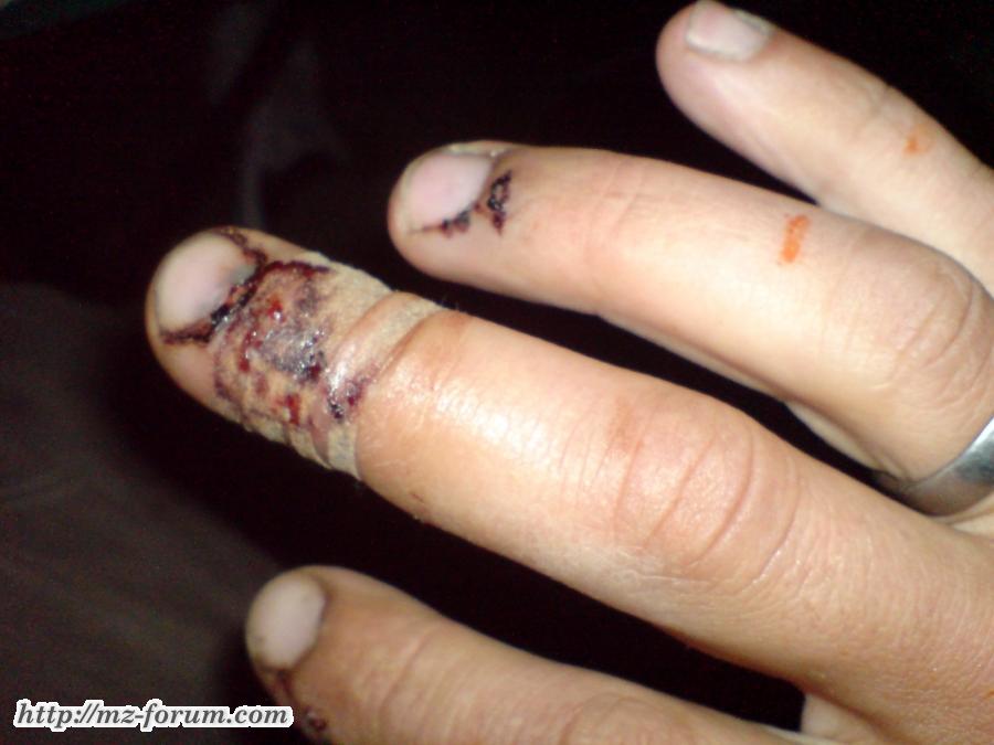 Finger put